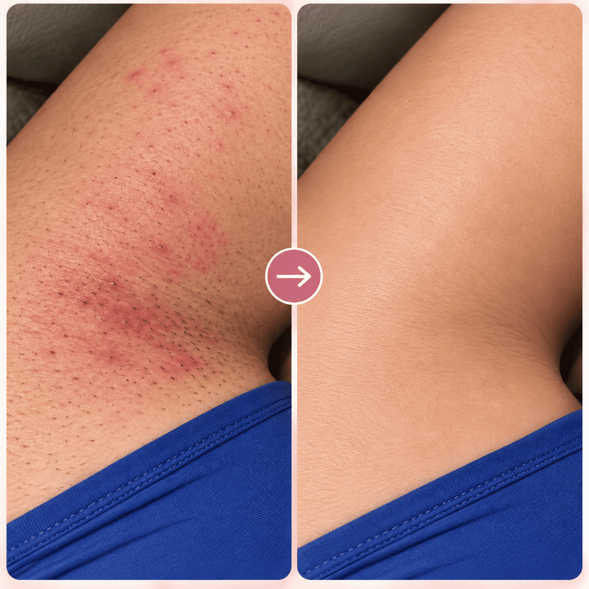 Depiladora Laser IPL Pro - Menos irritación. Menos vello. Más suavidad.