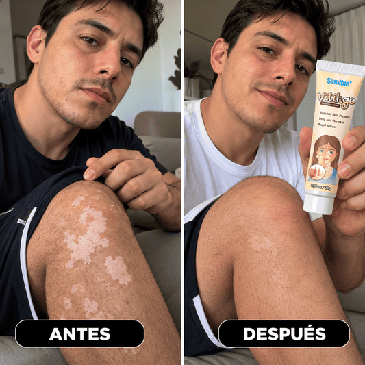 SUMIFUN VITILIGO CREMA ELIMINADORA 20g