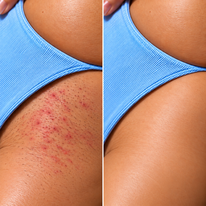 Depiladora Laser IPL Pro - Menos irritación. Menos vello. Más suavidad.